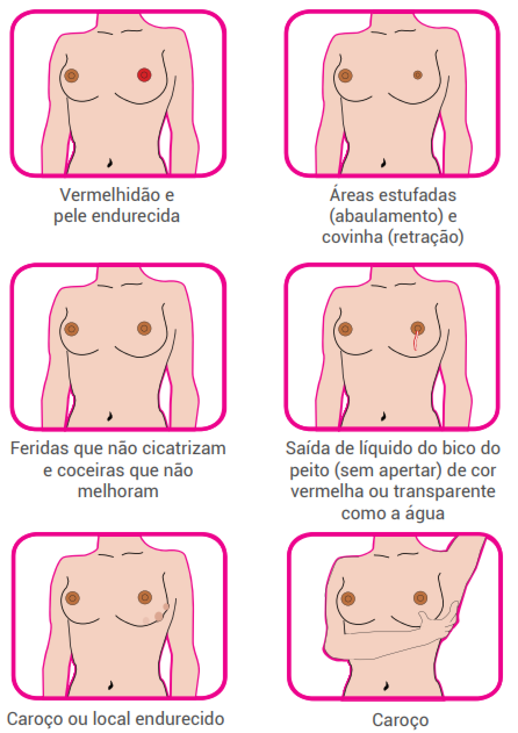 O que você precisa saber sobre o Câncer de Mama