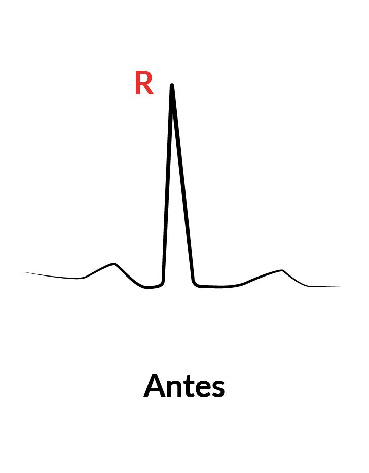 eletrocardiograma