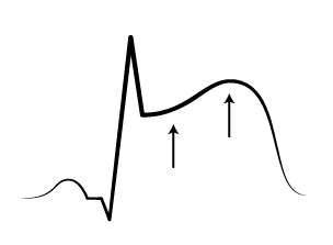 eletrocardiograma