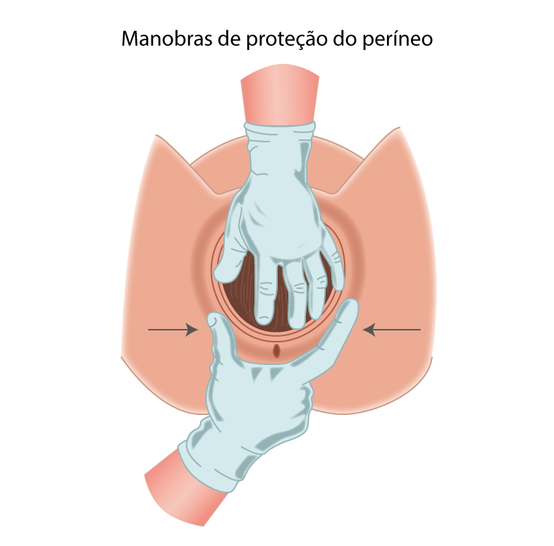 manobra de proteção do períneo